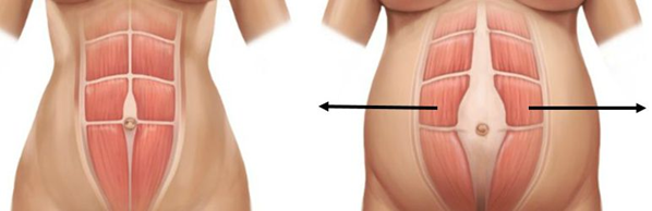 Diastasis Diastasis