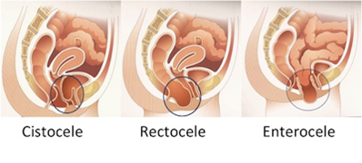 Prolapso vaginal Prolapso vaginal