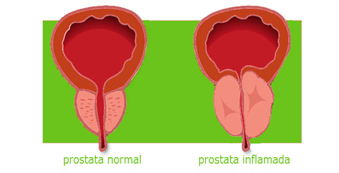 Prostata Prostata