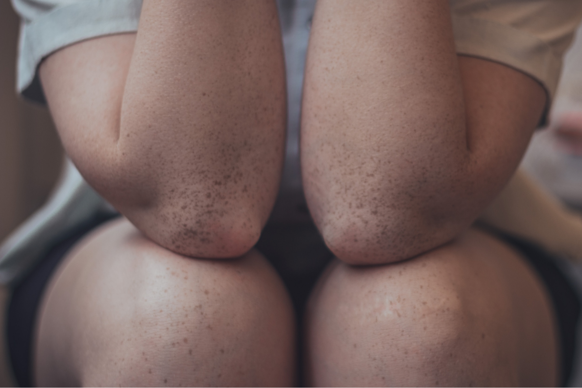 Esguince de rodilla